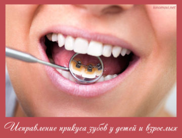 Исправление прикуса зубов у детей и взрослых
